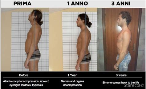 Lordosis Treatment Before After