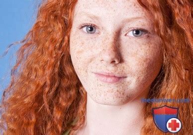 Топ-10 самых эффективных масок для отбеливания веснушек и пигментных ...