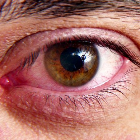 Ocular Rosacea Symptoms, Causes, and Treatment | Ozidex