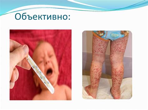 Острый лимфобластный лейкоз - презентация онлайн