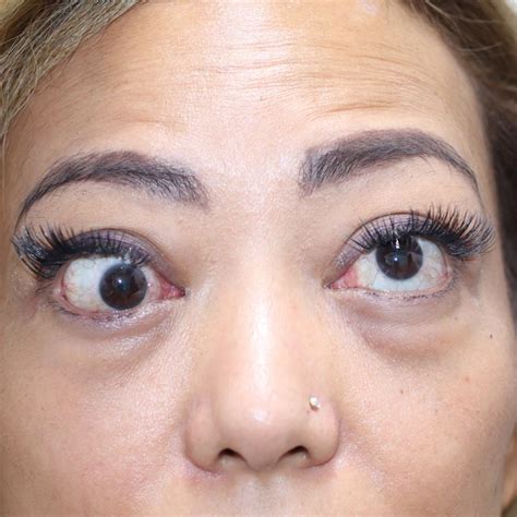 Thyroid Eye Disease Surgery Graves Eye Disease Surger - vrogue.co