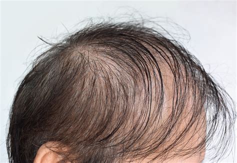 Male Pattern Hair Loss in Singapore - Dr. Jon Yong Aesthetic Clinic