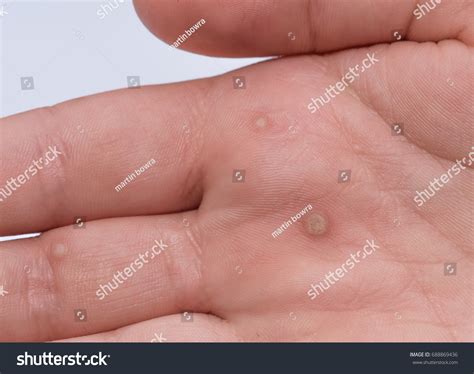 common wart images stock  vectors shutterstock