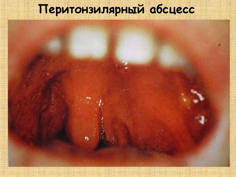 Атлас - стрептококковая инфекция - online presentation