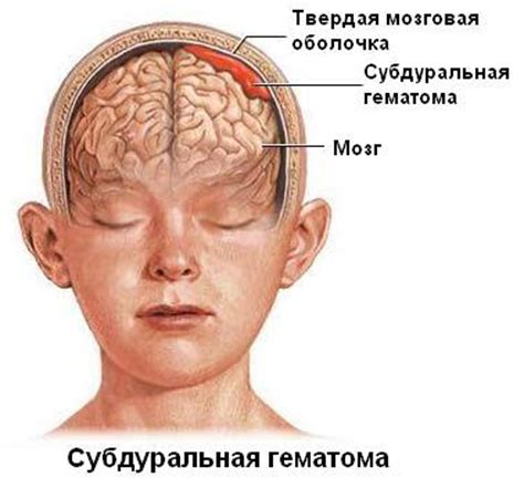 Внутричерепная гематома гематома головы головного мозга кровоизлияние в ...