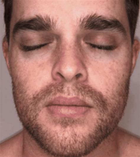 BBL Treatments | Laser Clinics New Zealand