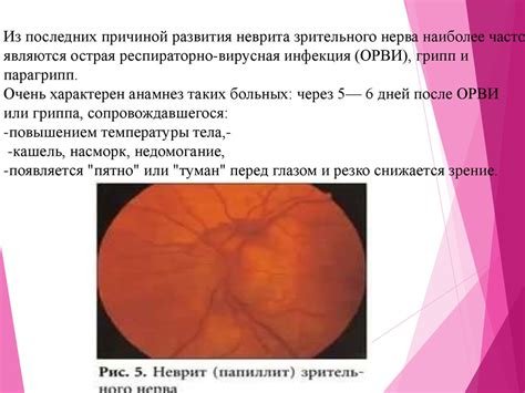 Зрительный нерв - презентация онлайн