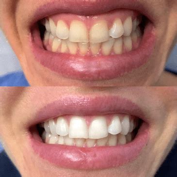 Inopro whitening – inopro
