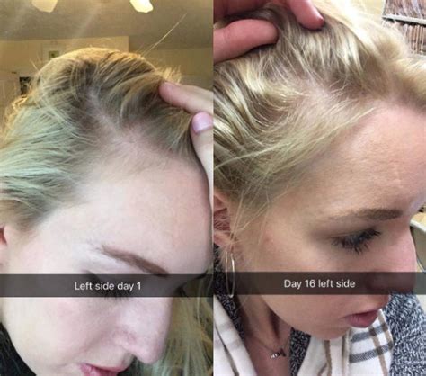 What Does Dead Hair Look Like? - Meditation Bro