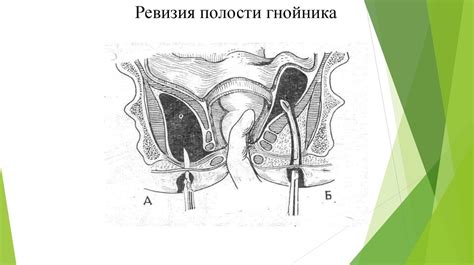 Острый и хронический парапроктит - презентация онлайн