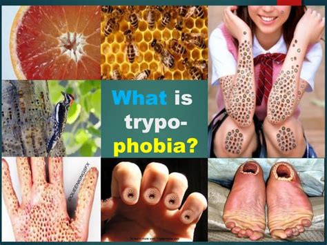 holes  skin disease trypophobia