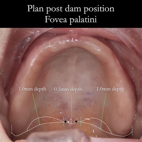 post dam position  maxillary complete dentures  fovea palatini