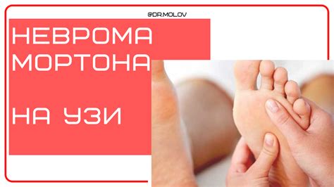 Неврома Мортона на УЗИ - Клиника Молова М.Р
