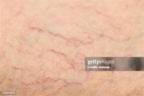 137 Teleangectasia Stock Photos, High-Res Pictures, and Images - Getty ...