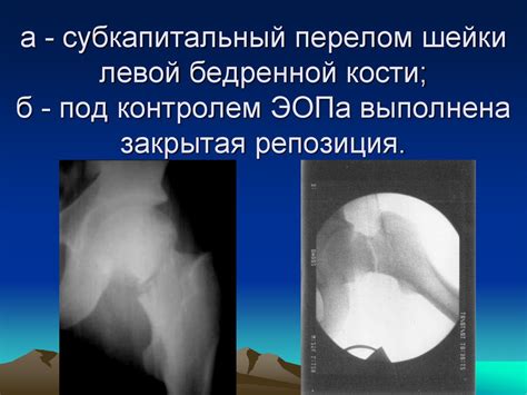 Переломы шейки бедра - презентация онлайн