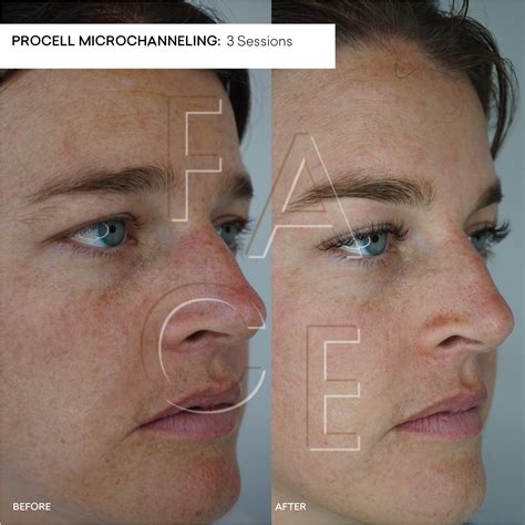 Procell Microchanneling Before and After — FACE