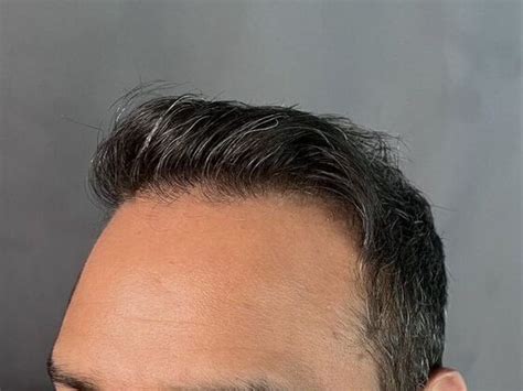 fue hair restoration