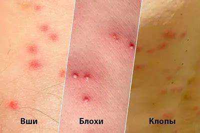 68+ Укусы блох и клопов фото