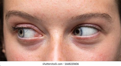 Eye Sideways Images, Stock Photos & Vectors | Shutterstock