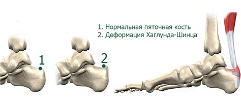 Болезнь Шинца - причины, симптомы и методы лечения