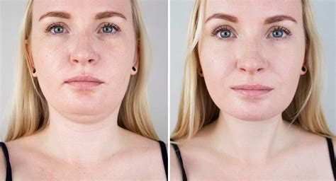 What Is The Best Treatment For Double Chin 