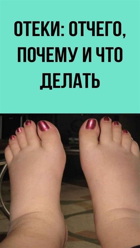 Отеки: отчего, почему и что делать | Лечение ног, Лечение ...