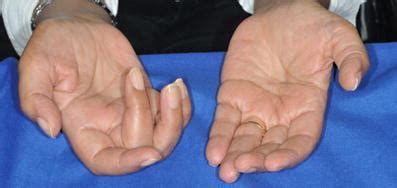 Atrophy of thenar eminence and weakness of finger extensors, more ...