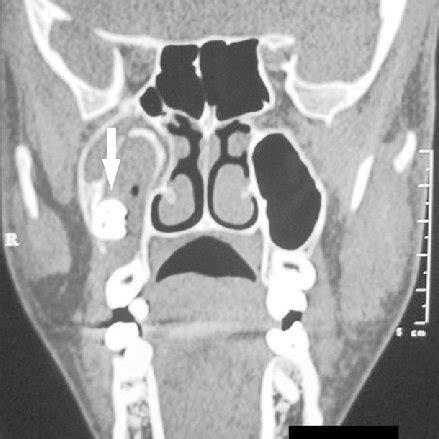 (PDF) Infected Dentigerous Cyst of Maxillary Sinus Arising from an Ectopic Third Molar
