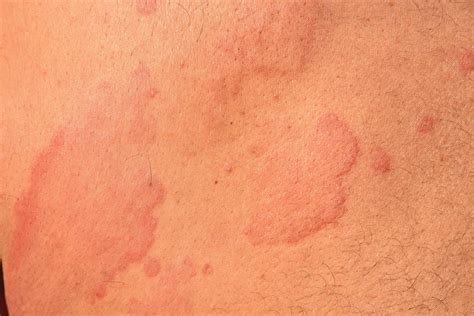 Hives vs. Rash: Symptoms, Causes, Treatment