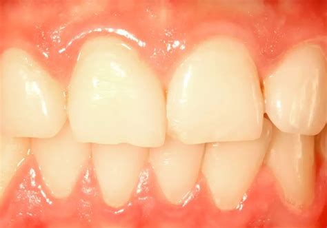 Naturally Regenerating Bone Loss in Teeth: Tips and Tricks