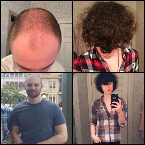 A quick before and after to show the potential for hair regrowth on ...