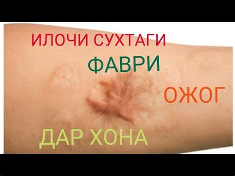 Давои сухтаги.سوختن بدن.Лечение ожогов.Burn treatment.Yanık tedavisi ...
