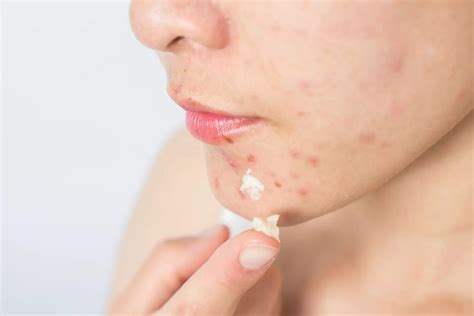 Teramisin Krem Nedir? Terramycin Krem Ne İşe Yarar? Nasıl Kullanılır ...