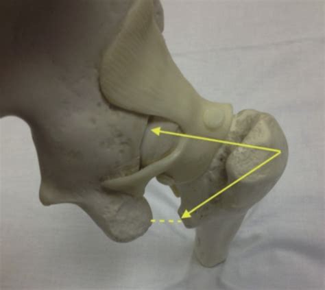 Ischiofemoral Impingement Test | Ischiofemoral Hip Impingement