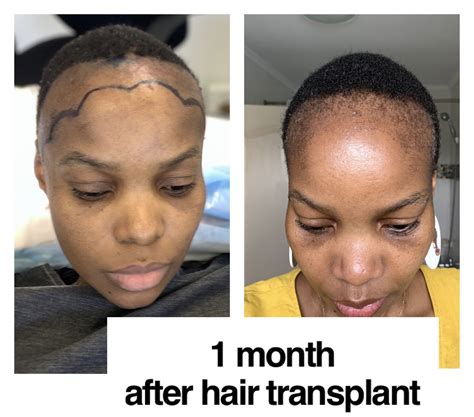 how much are hair implants 1