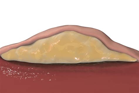 Giant Lipoma Pain - Infoupdate.org