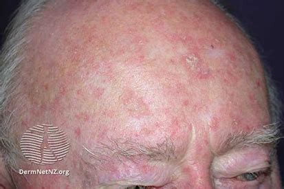 actinic keratosis   treatment riva dermatology