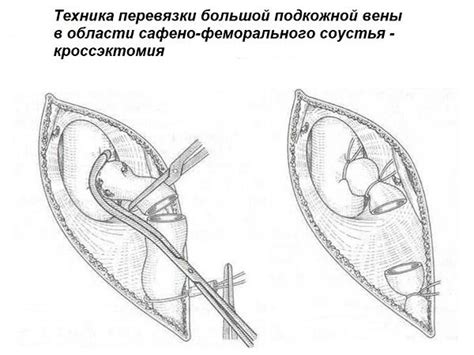 Кроссэктомия - операция Троянова-Тределенбурга