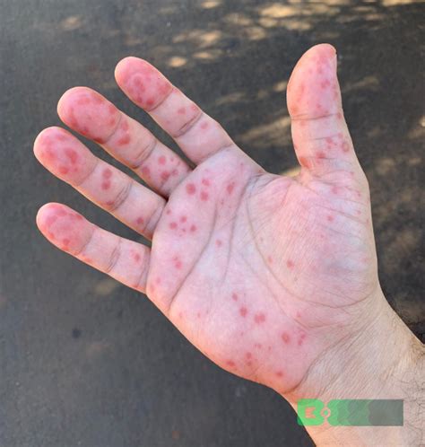 Dengue Da Coceira Nas Mãos E Pés - Bolhas De Coceira Coceira Na Pele Pode Ser Brotoeja | Portal Diário