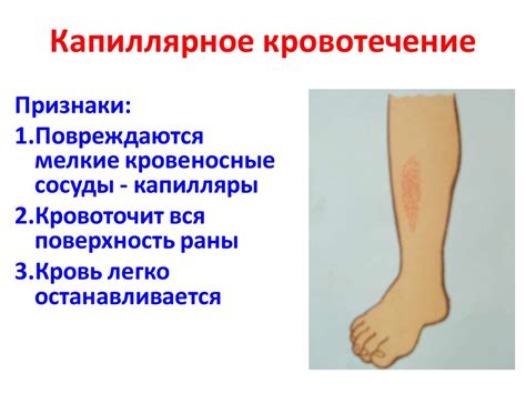 Виды кровотечений, первая медицинская помощь при кровотечениях ...