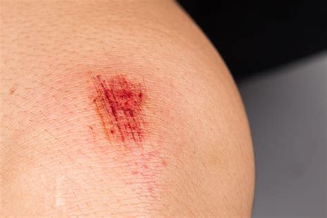 facts  abrasion factsnet