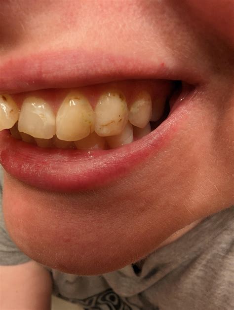 Why do my teeth look like this and what can I do about it? : r/askdentists