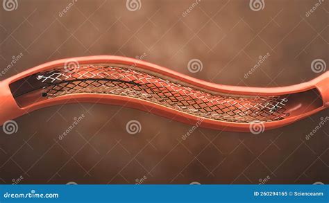 repairing  blocked artery stock illustration illustration  balloon