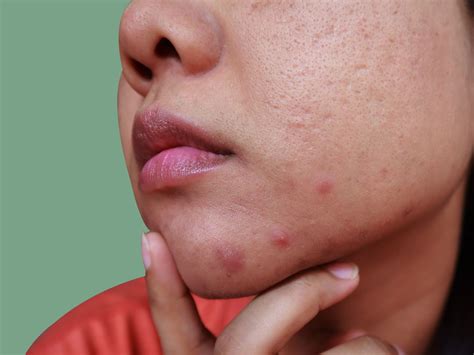 chin acne    treat    dermatologists