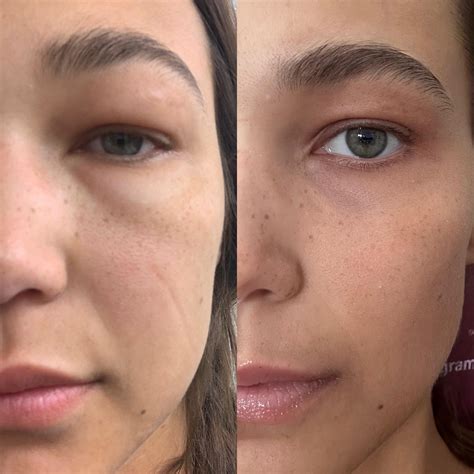 My face before and after kidney transplant (one week out) : r/transplant