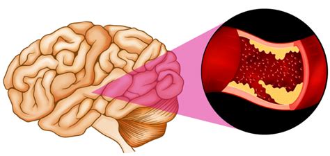 Ischemic Stroke | Altair Health