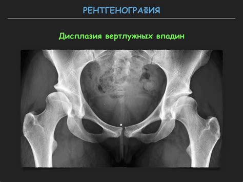 Визуализация тазобедренного сустава