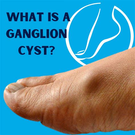Complete Podiatry - [WHAT ARE GANGLION CYSTS?] . Have you had a funny