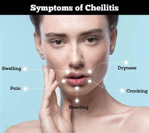Cheilitis - Causes, Symptoms, Diagnosis & Treatment