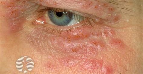 Eyelid herpes simplex image